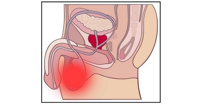Una complicación de la cirugía de agrandamiento del pene puede ser la inflamación de los testículos. 