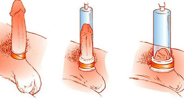 El principio de funcionamiento de una bomba de vacío que puede agrandar el pene. 